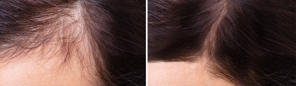 Hair Loss treatment | Clear Skin Clinic
