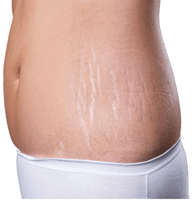 Best treatment for stretch marks