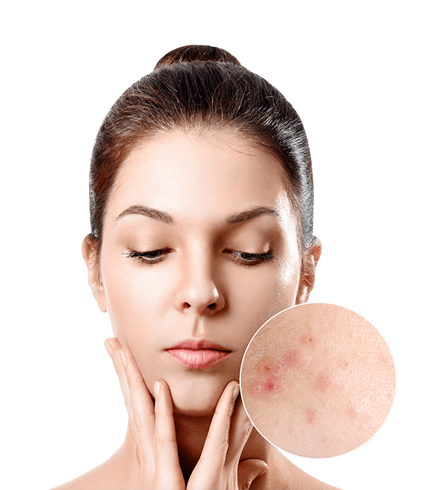 Best Acne removal doctor